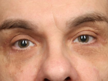 Blepharoplasty Before & After Patient #10510