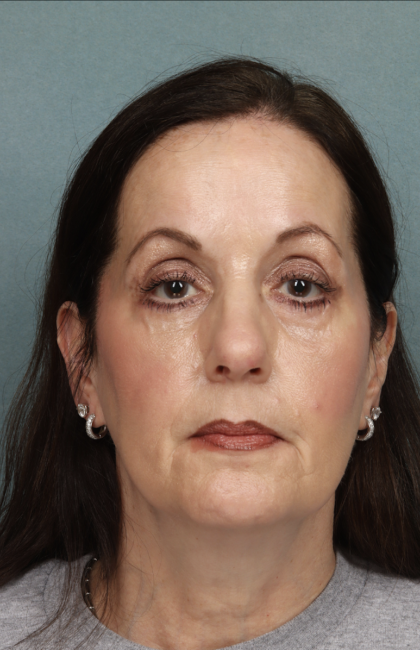 Blepharoplasty Before & After Patient #10514