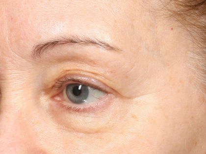 TCA Peel Before & After Patient #10552