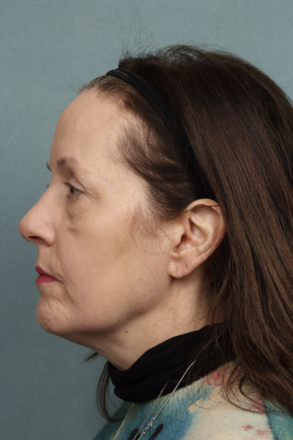 Blepharoplasty Before & After Patient #10514