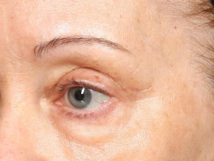 TCA Peel Before & After Patient #10552