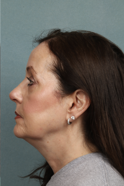 Blepharoplasty Before & After Patient #10514