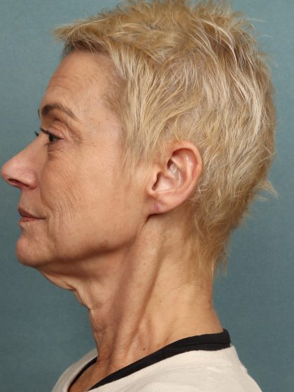 Fat Grafting Before & After Patient #10574
