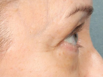 TCA Peel Before & After Patient #10552