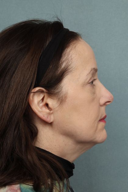 Blepharoplasty Before & After Patient #10514