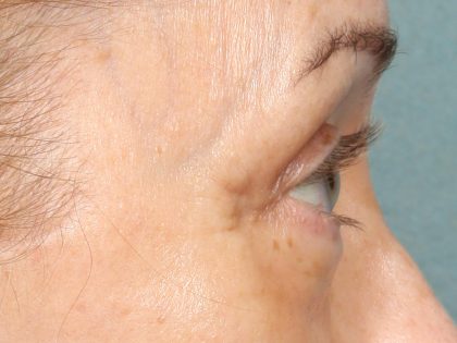 TCA Peel Before & After Patient #10552