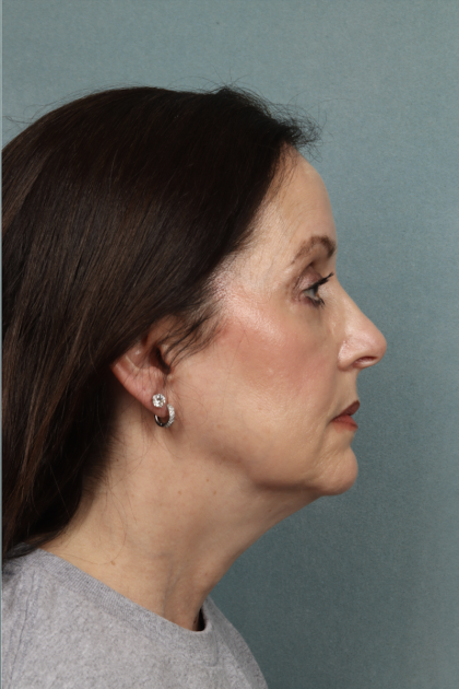 Blepharoplasty Before & After Patient #10514