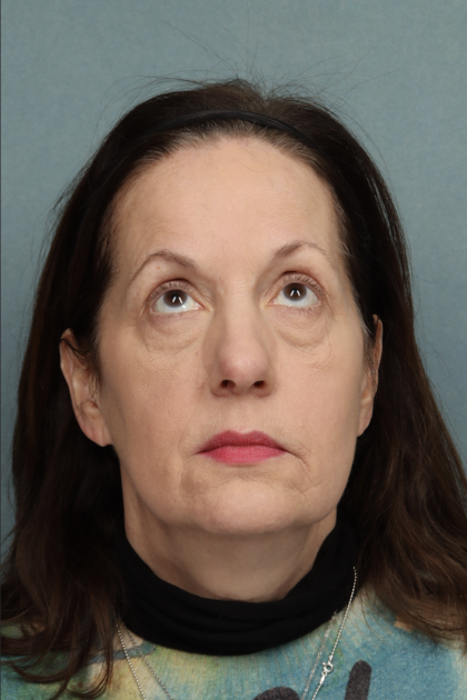 Blepharoplasty Before & After Patient #10514