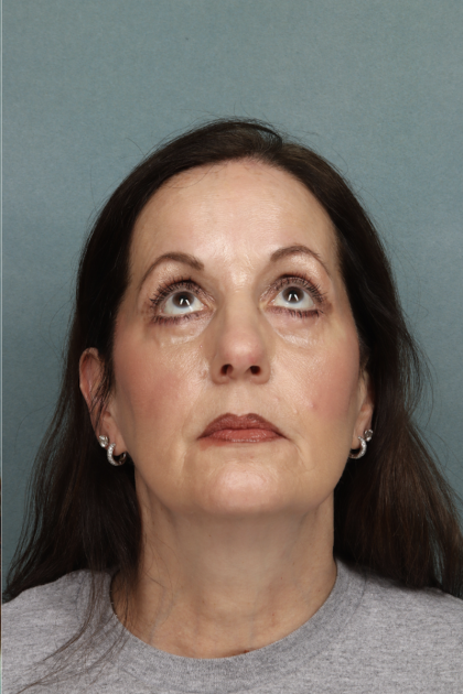 Blepharoplasty Before & After Patient #10514