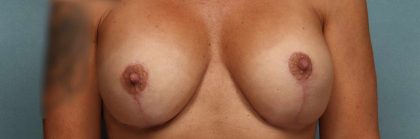 Oncoplastic Reconstruction Before & After Patient #10559