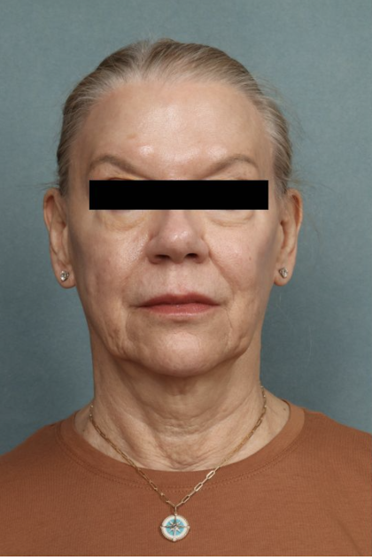 Facelift Before & After Patient #10562