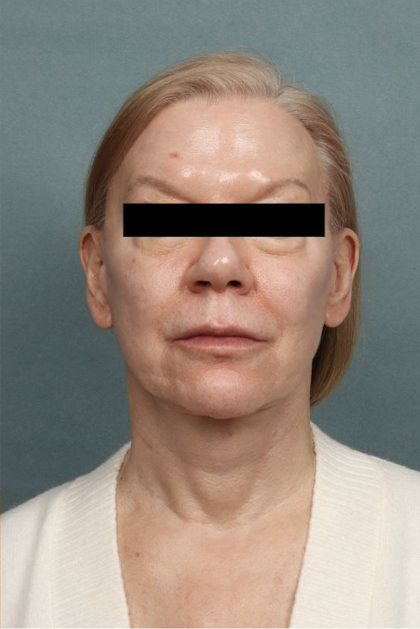 Facelift Before & After Patient #10562