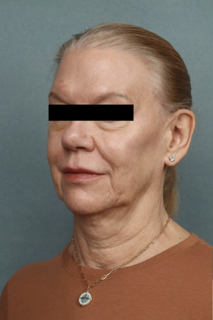 Facelift Before & After Patient #10562