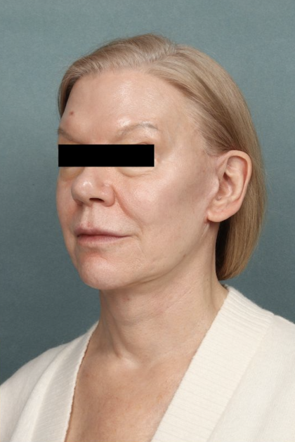 Facelift Before & After Patient #10562