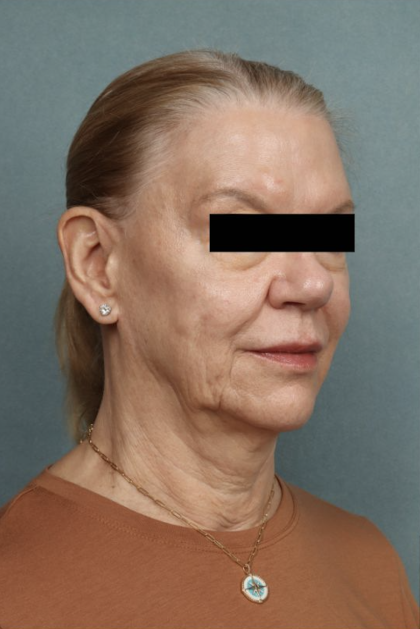 Facelift Before & After Patient #10562