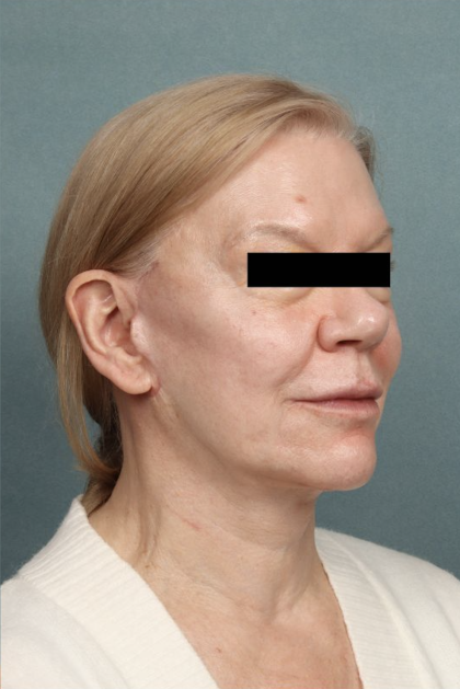 Facelift Before & After Patient #10562