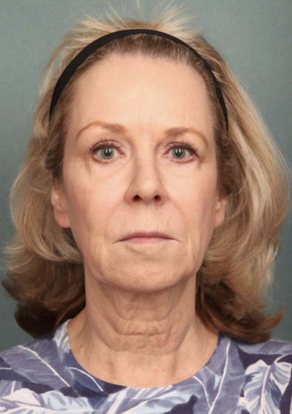 Chemical Peel Before & After Patient #10627