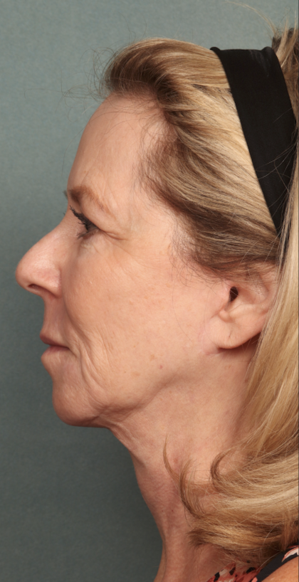 Chemical Peel Before & After Patient #10627