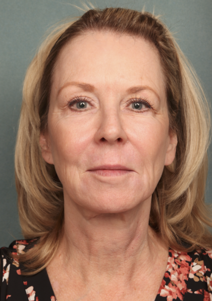 Chemical Peel Before & After Patient #10627