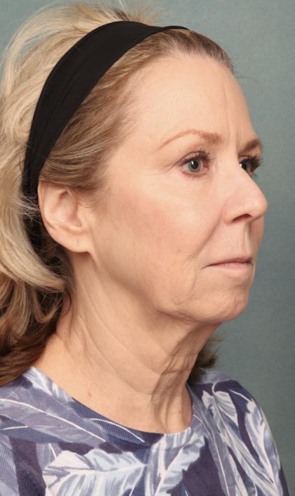 Chemical Peel Before & After Patient #10627