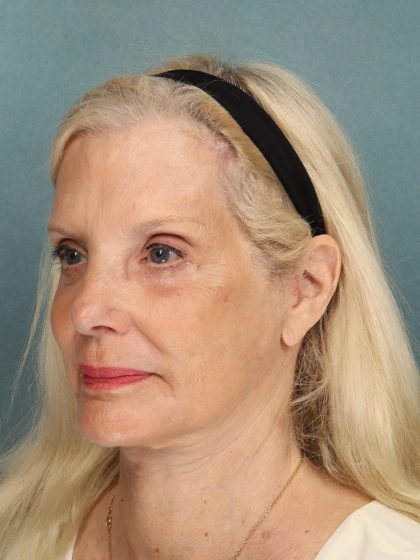 Eye Lift Before & After Patient #10607