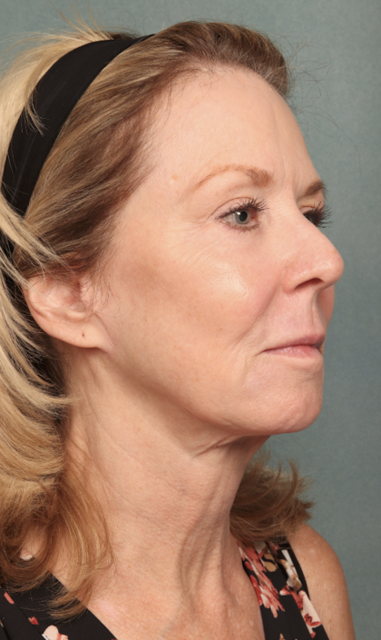 Chemical Peel Before & After Patient #10627