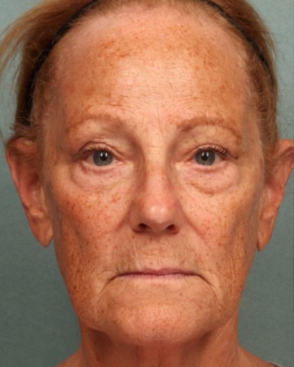 Blepharoplasty Before & After Patient #10585