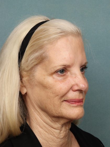 Eye Lift Before & After Patient #10607