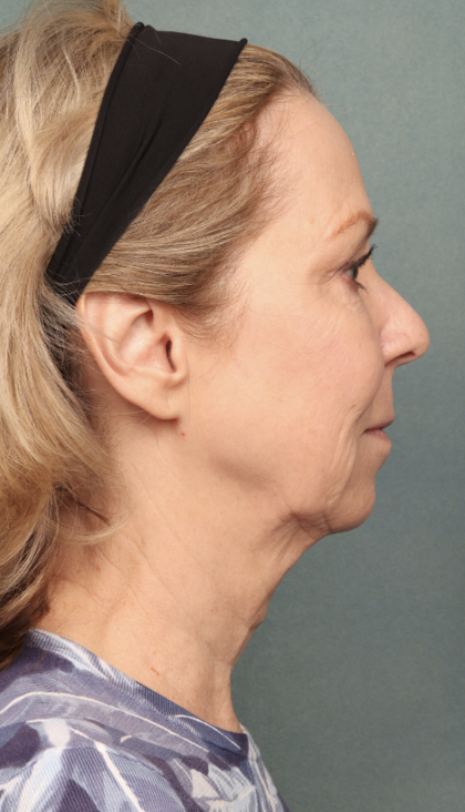 Chemical Peel Before & After Patient #10627