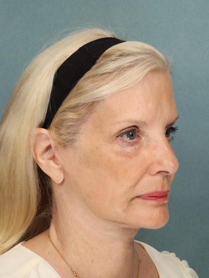 Eye Lift Before & After Patient #10607