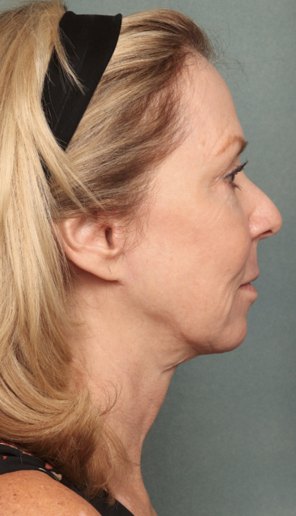 Chemical Peel Before & After Patient #10627