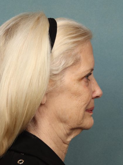 Eye Lift Before & After Patient #10607