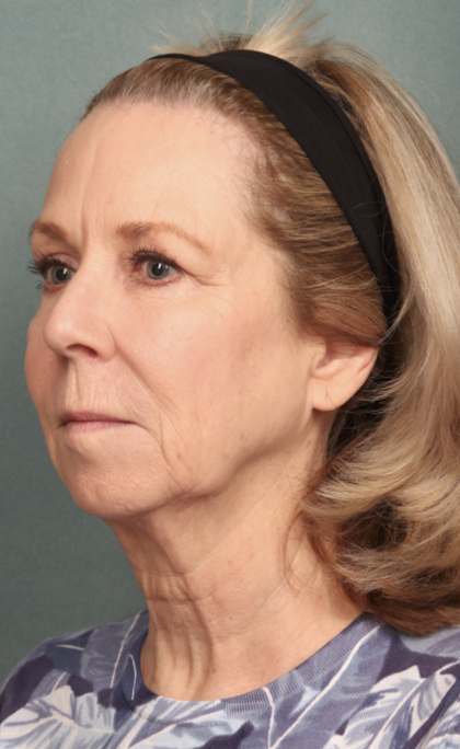 Chemical Peel Before & After Patient #10627