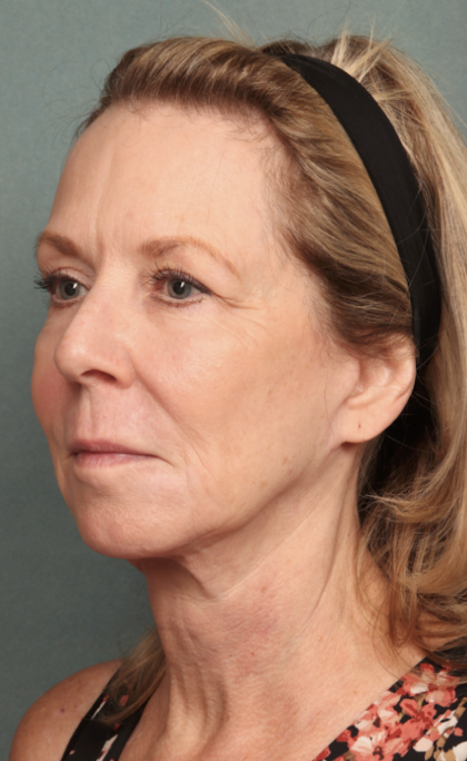 Chemical Peel Before & After Patient #10627