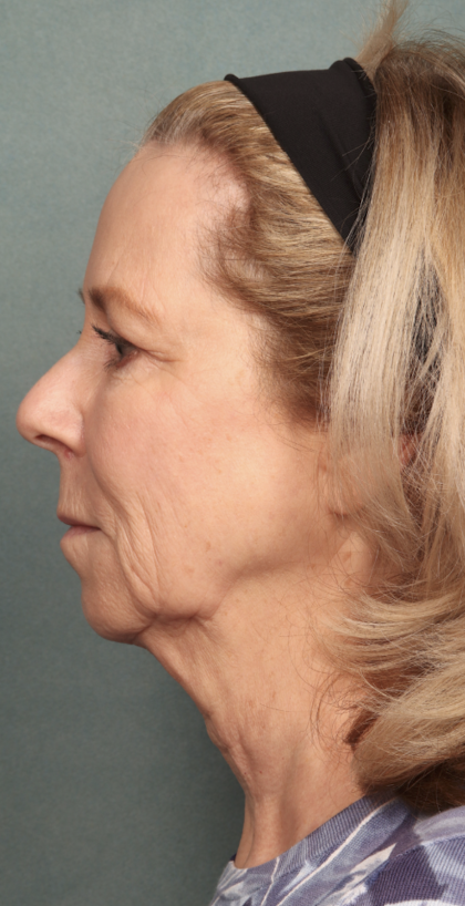 Chemical Peel Before & After Patient #10627