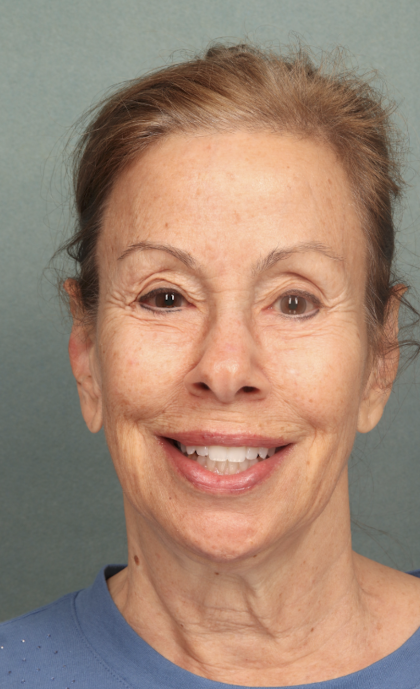 Facelift Before & After Patient #9913