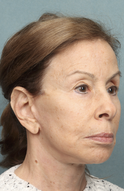 Facelift Before & After Patient #9913