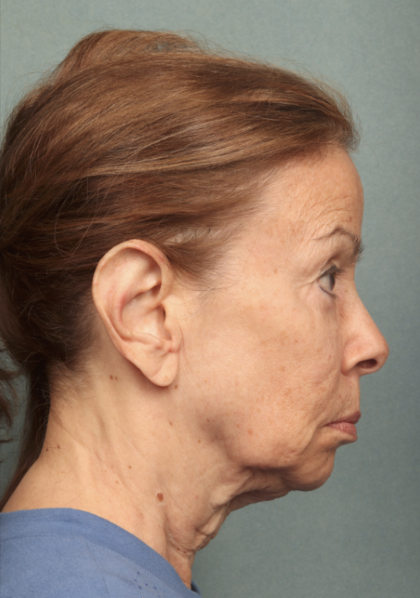 Facelift Before & After Patient #9913