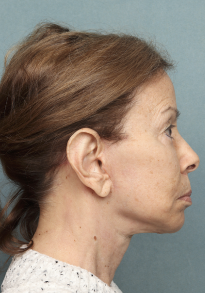 Facelift Before & After Patient #9913