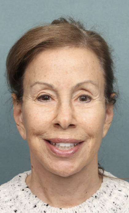 Facelift Before & After Patient #9913