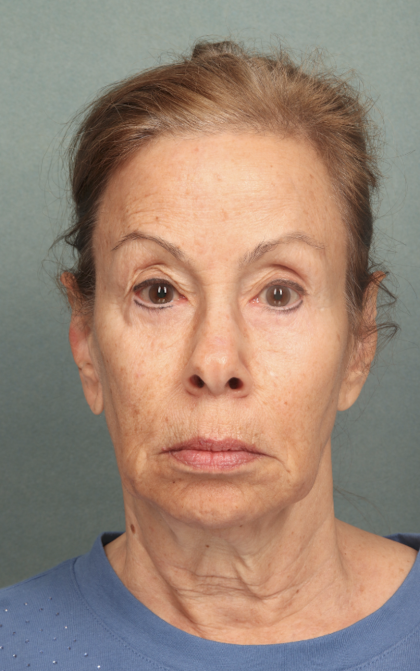 Facelift Before & After Patient #9913