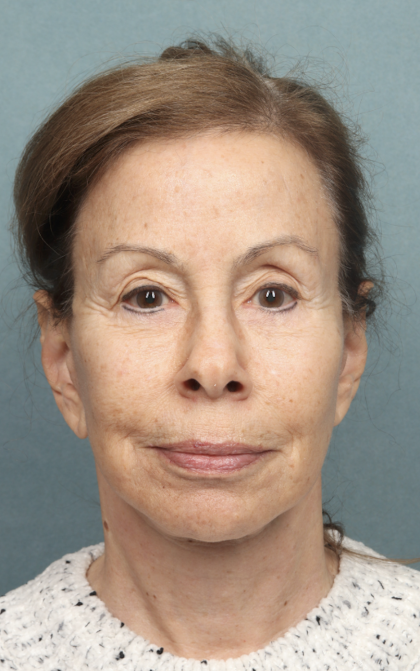 Facelift Before & After Patient #9913
