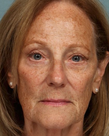 Blepharoplasty Before & After Patient #10585