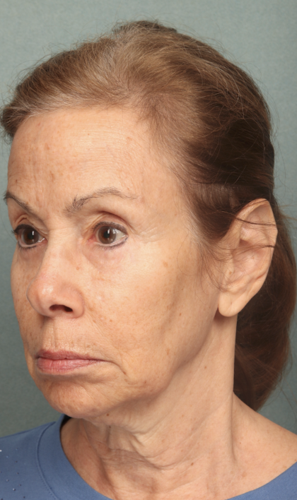 Facelift Before & After Patient #9913
