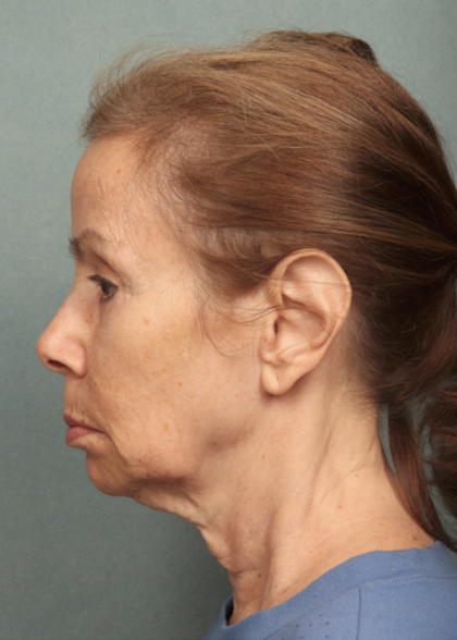 Facelift Before & After Patient #9913