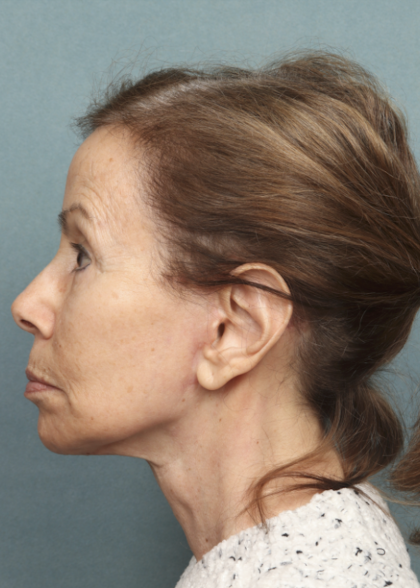 Facelift Before & After Patient #9913
