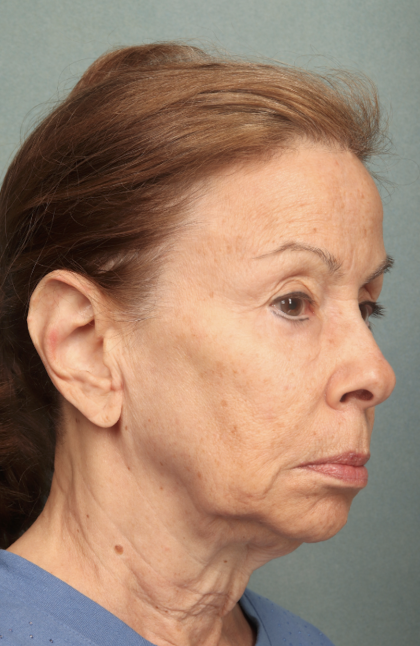 Facelift Before & After Patient #9913