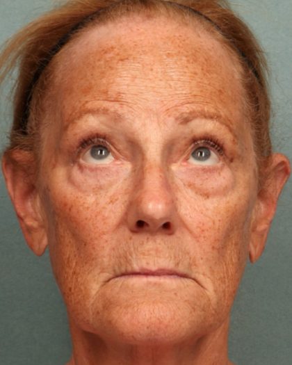 Blepharoplasty Before & After Patient #10585