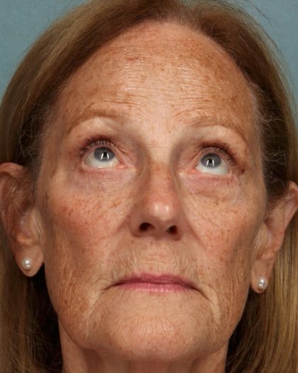 Blepharoplasty Before & After Patient #10585
