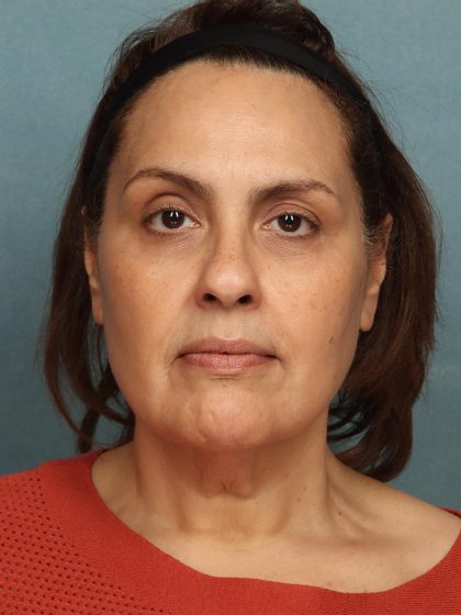 Facelift Before & After Patient #10623